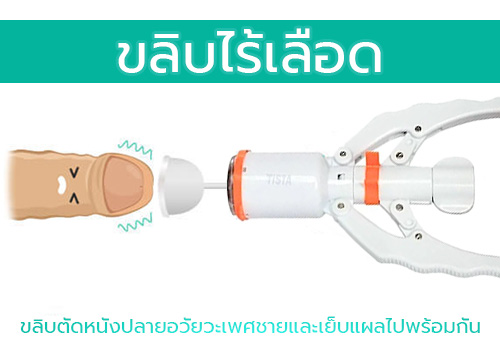 ขลิบไร้เลือด บทความ_0 การขลิบไร้เลือด (Staple Circumcision)