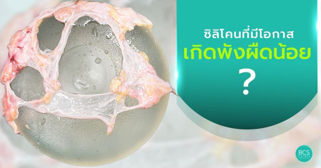 ซิลิโคนที่ลดพังผืดได้ดีที่สุด คือ Polyurethane Foam จริงหรือไม่?