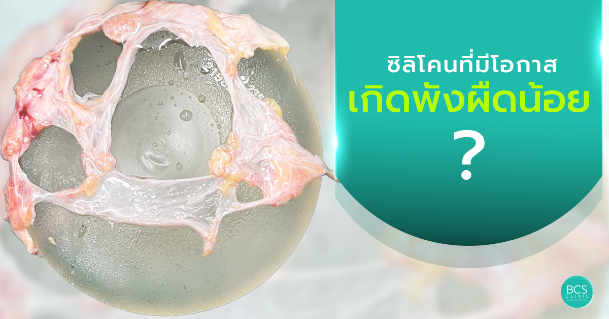 ซิลิโคนที่ลดพังผืดได้ดีที่สุด คือ Polyurethane Foam จริงหรือไม่?