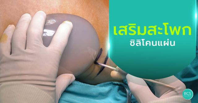 เสริมสะโพกด้วยวัสดุแบบแผ่น ข้อดี ข้อเสีย และสิ่งที่ควรรู้