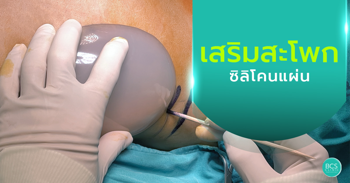 เสริมสะโพกด้วยวัสดุแบบแผ่น ข้อดี ข้อเสีย และสิ่งที่ควรรู้